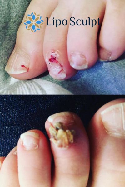Wart removal customer results from Lipo Sculpt West Mersea
